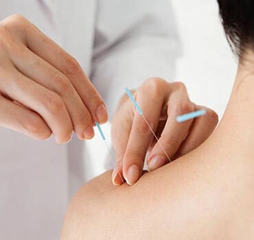  Best acupuncture treatments in Mississauga