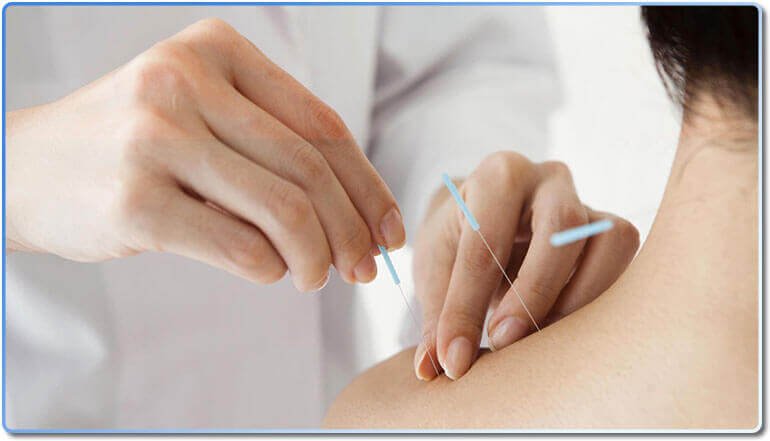 Best acupuncture and traditional chinese medicine in Mississauga